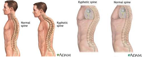 Posture disorders infographics. Flat back posture. The side view