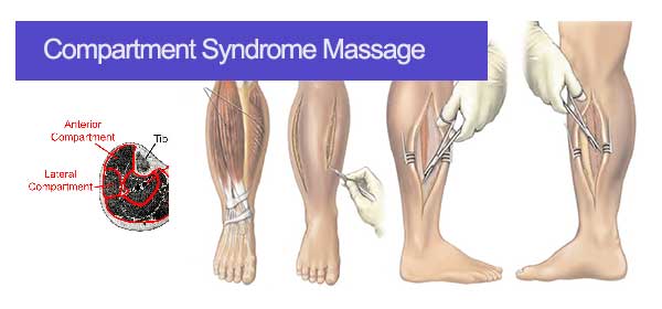 compartment syndrome massage