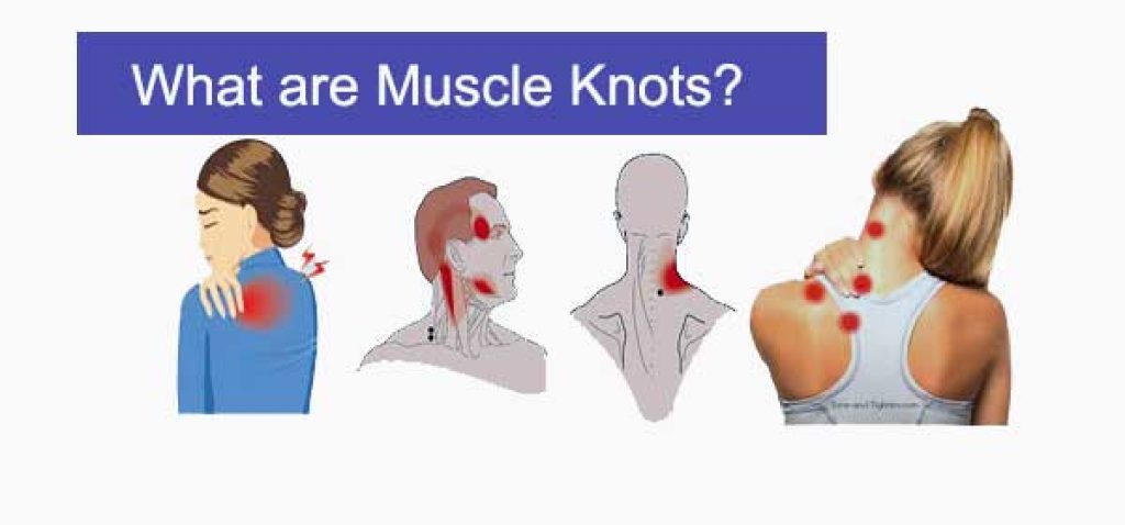 What Are Muscle Knots? 