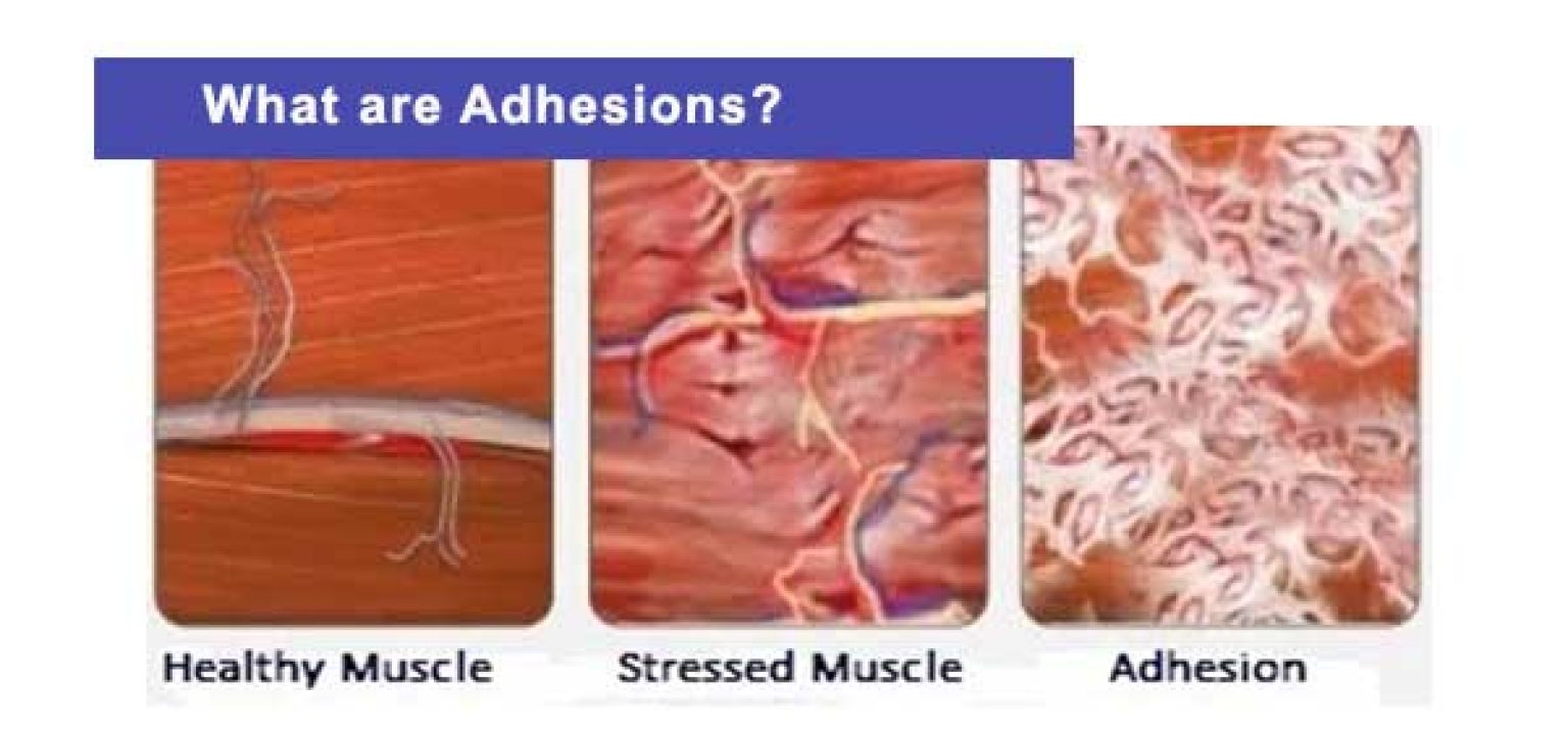 What Are Adhesions? | Medical Massage Therapy